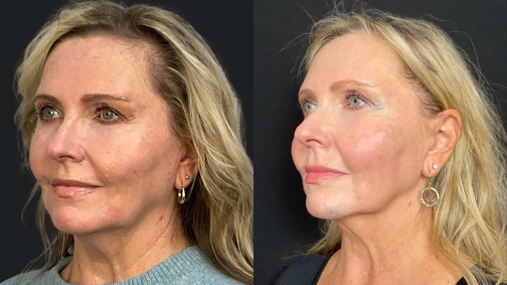Sciton clinical image: BBL and MOXI before and after