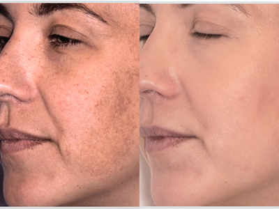 BBL and MOXI before and after for freckles and brown sun spots on the cheek at Epiphany Clinic in American Fork, UT