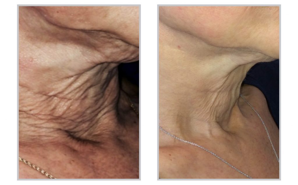 Sciton clinical image: SkinTyte before and after on crepey neck skin