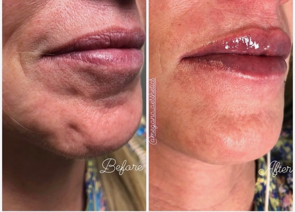 Lip and chin filler before and after at Epiphany Clinic