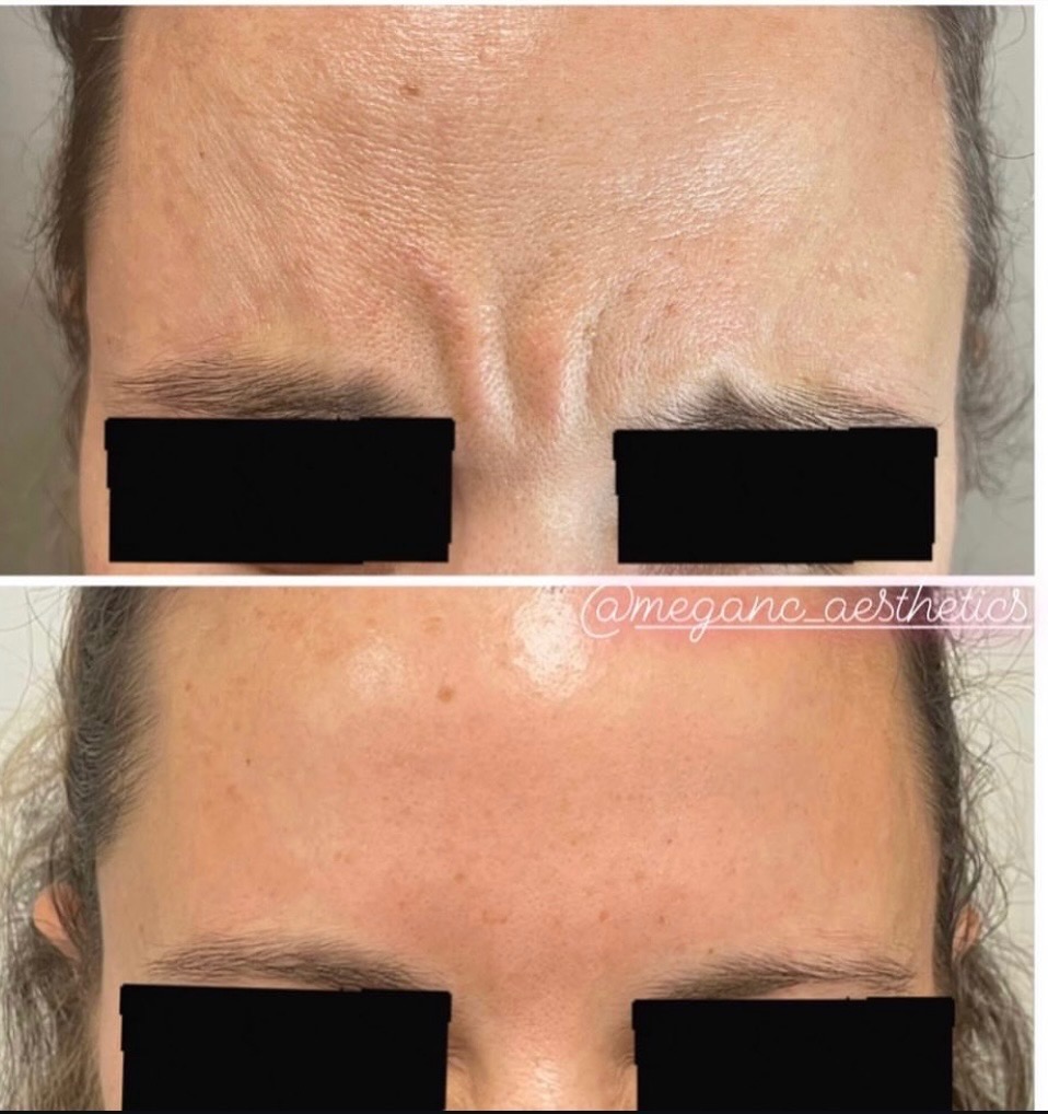 Botox Before and afters elevens