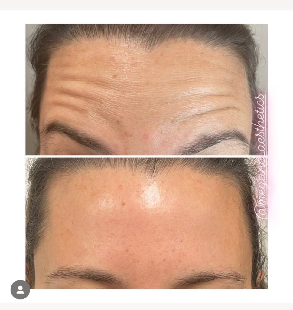 Botox before and after for forehead lines at Epiphany Clinic in American Fork, UT